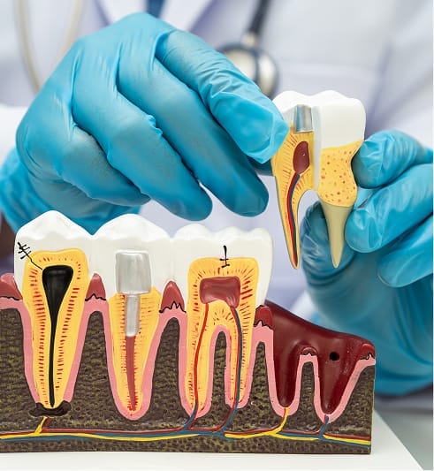 Dentist holding a tooth model illustrating root canal therapy, showing infected pulp removal and internal tooth structure.